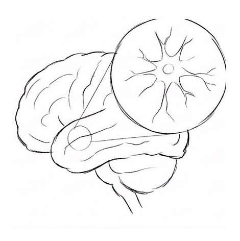 Alzheimer's Disease — educational illustration