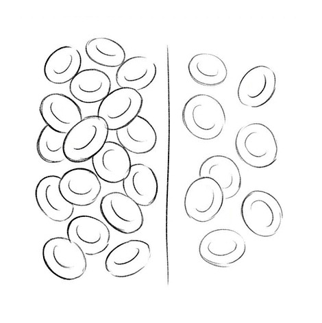Anemia — educational illustration