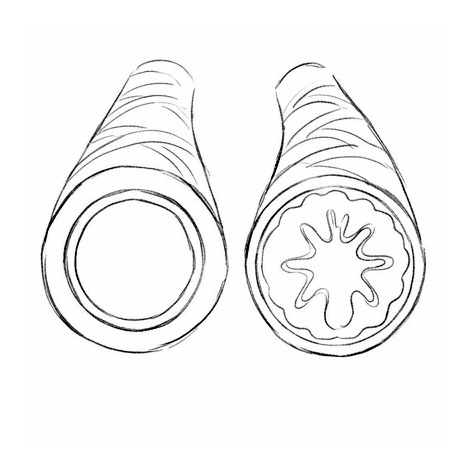 Asthma — educational illustration