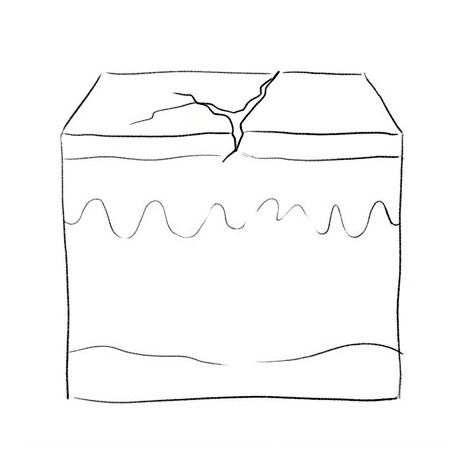 Atopic Dermatitis — educational illustration