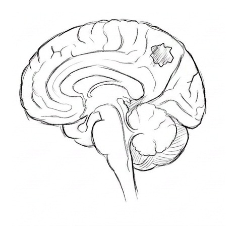 Brain Tumors: Symptoms and Evaluation — educational illustration