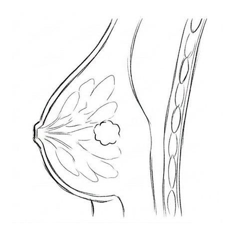 Breast Cancer — educational illustration