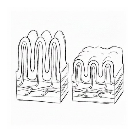 Celiac Disease — educational illustration