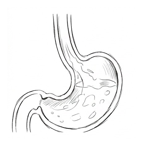 Gastroesophageal Reflux Disease — educational illustration