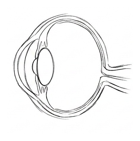 Glaucoma — educational illustration