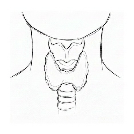 Hypothyroidism — educational illustration