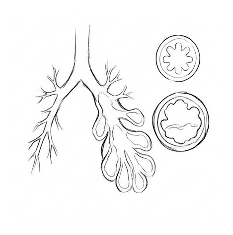Airways and Bronchiectasis — educational illustration