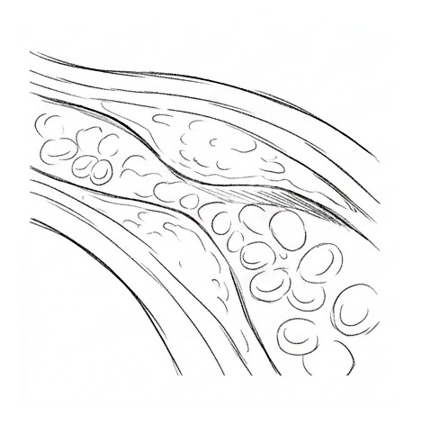 Cholesterol and Cardiovascular Risk — educational illustration