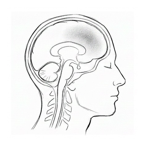 Migraine — educational illustration