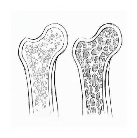 Osteoporosis — educational illustration