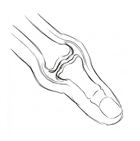 Rheumatoid Arthritis — educational illustration