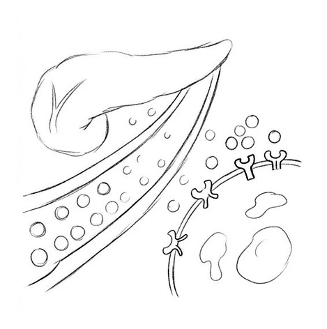 Type 2 Diabetes — educational illustration